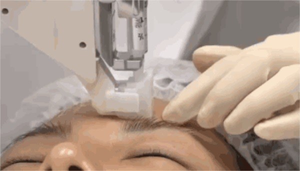 什么是玻尿酸玻尿酸的作用(什么是玻尿酸夏凉被)-第5张图片-