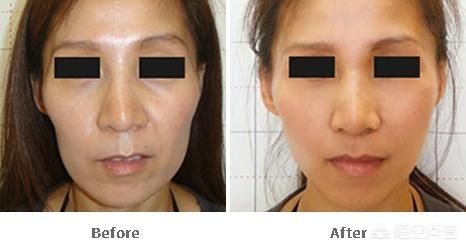 什么是玻尿酸玻尿酸的作用(什么是玻尿酸夏凉被)-第8张图片-