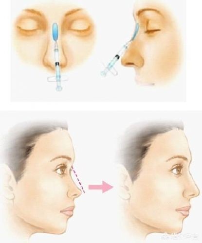 什么是玻尿酸玻尿酸的作用(什么是玻尿酸夏凉被)-第9张图片-