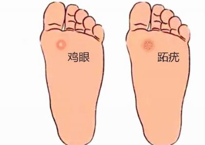 ​别再傻傻的把跖疣当成鸡眼了，这5招教您如何辨别