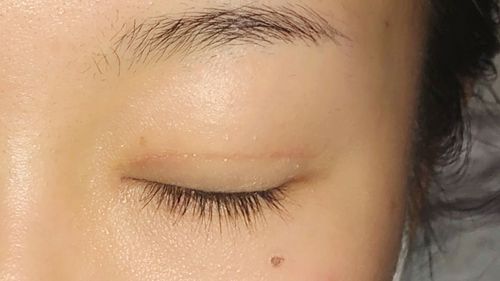 天生的双眼皮有痕迹（智慧型双眼皮真的）